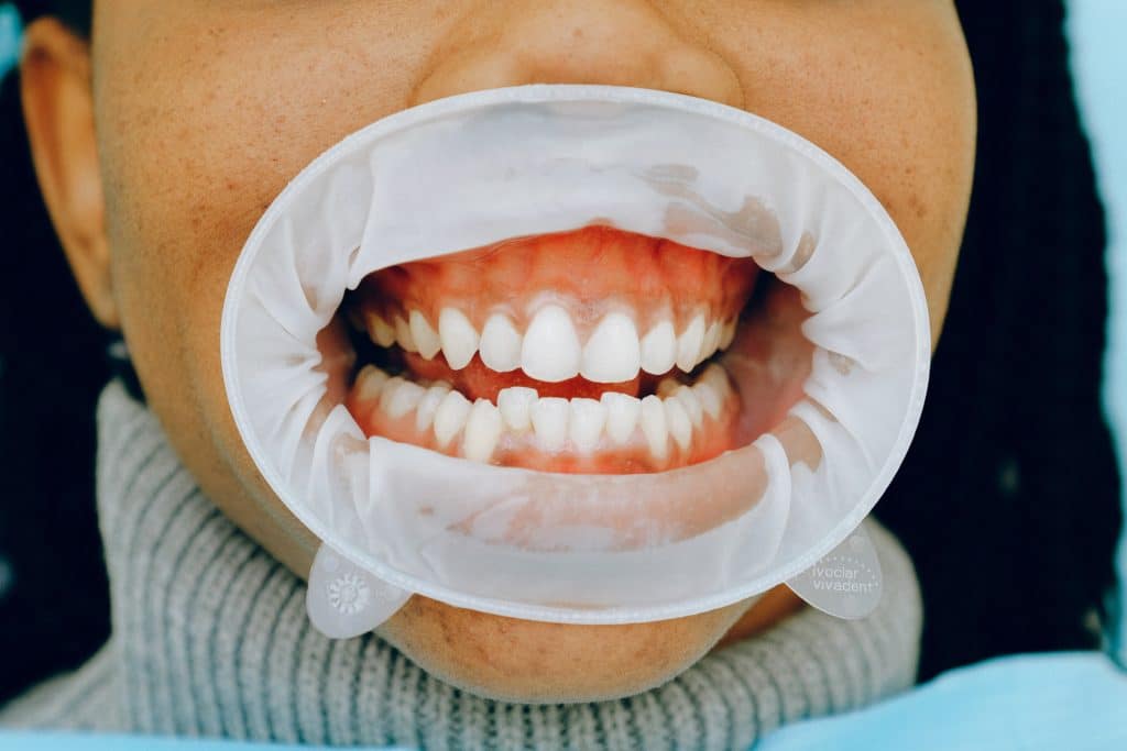 gum-disease-image