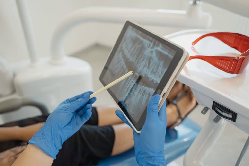 stages-of-tooth-decay-xray