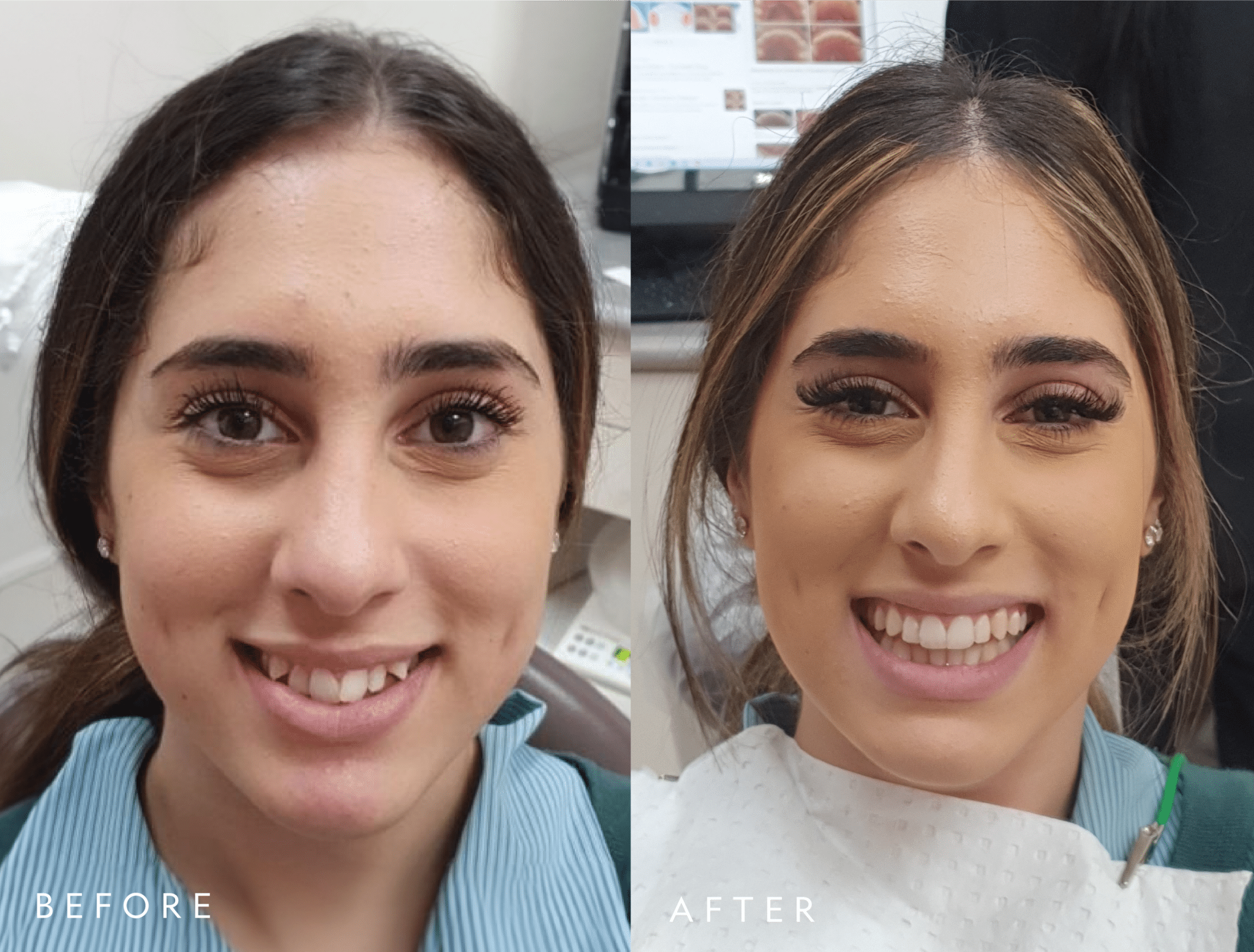 patient-2-invisalign-before-and-after