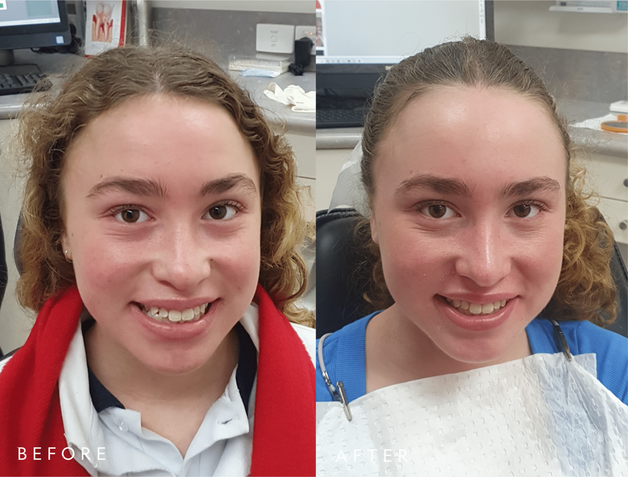 patient-invisalign-before-and-after