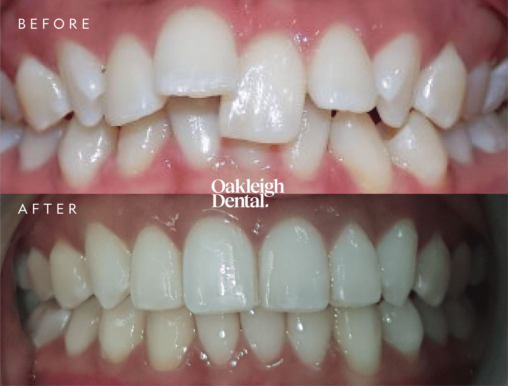 carla-invisalign-before-and-after