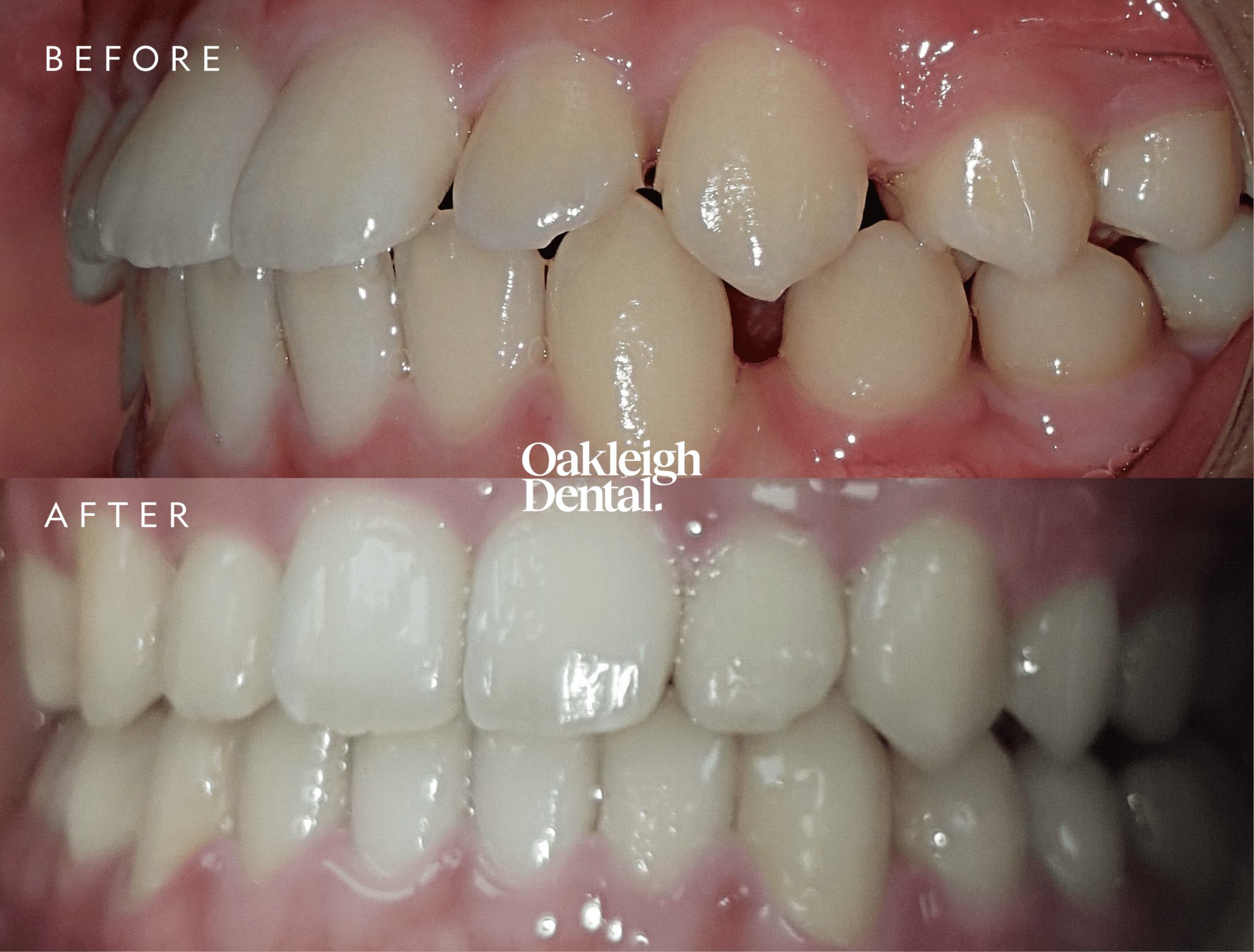 kane-shum-invisalign-before-and-after