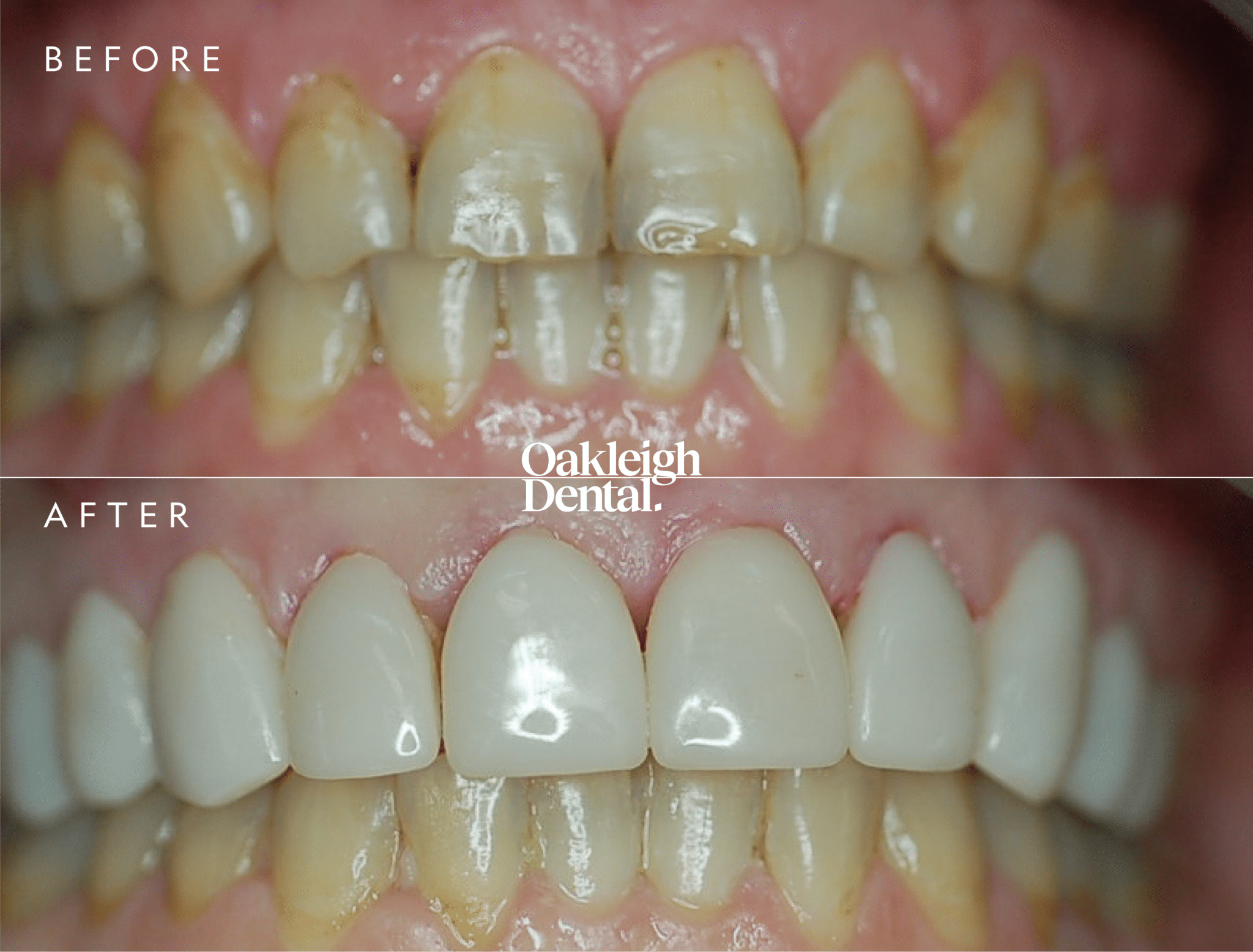 laticha-atherton-veneers-before-and-after