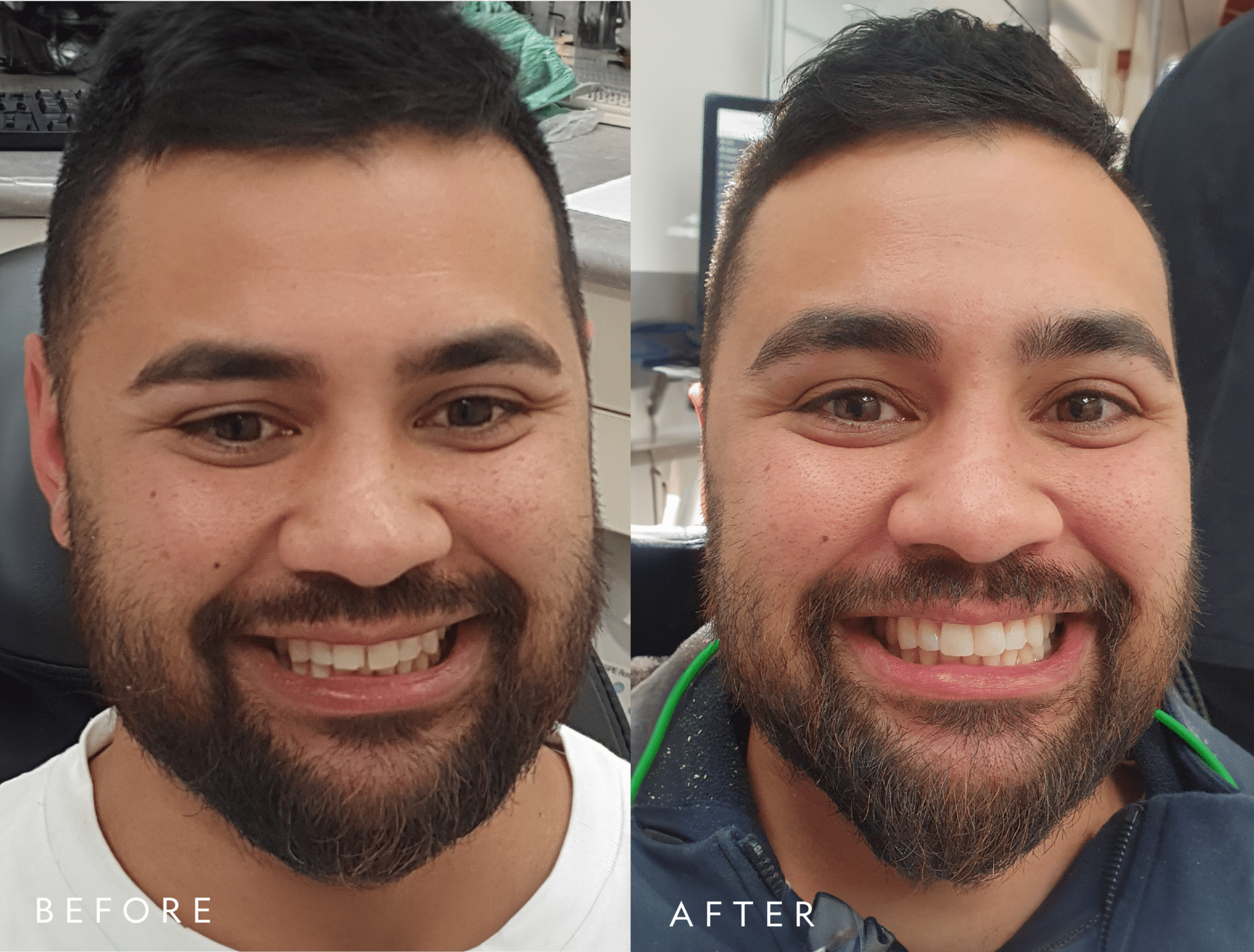 michael-invisalign-before-and-after