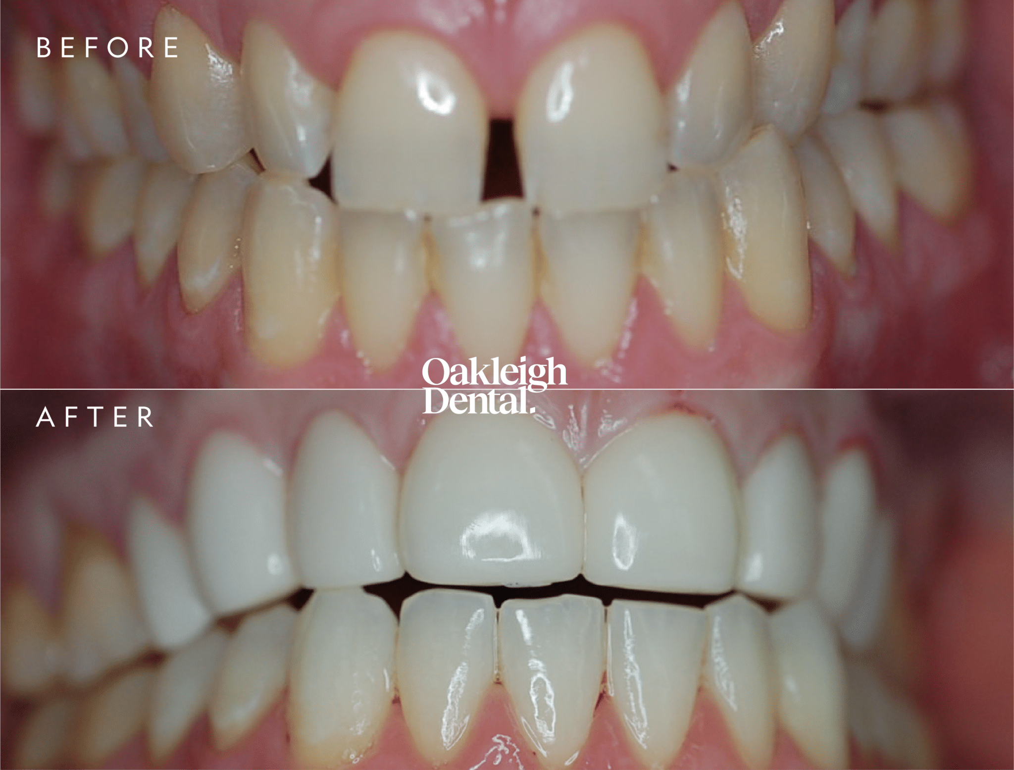 michael-tomic-veneers-before-and-after